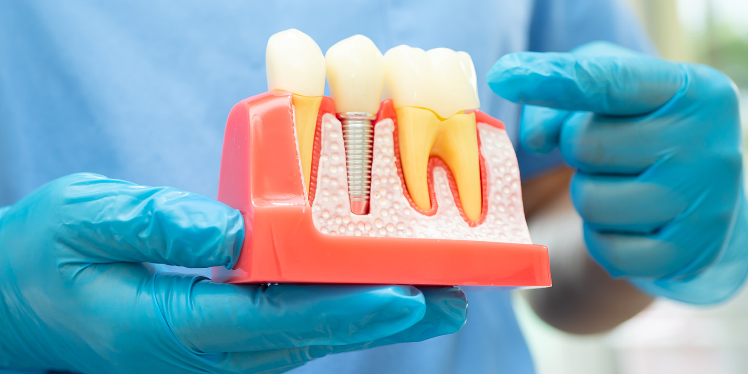 dental implant treatment options for missing teeth