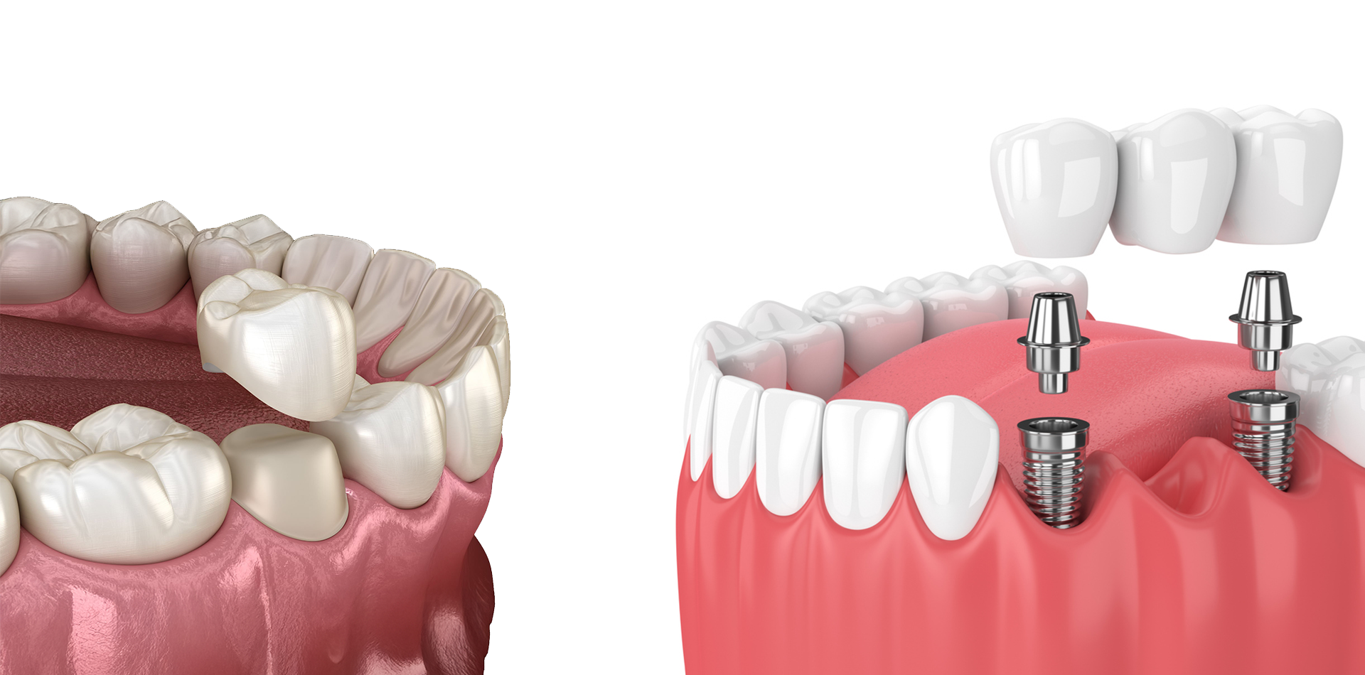 Dental Crowns and Bridge in Andheri West
