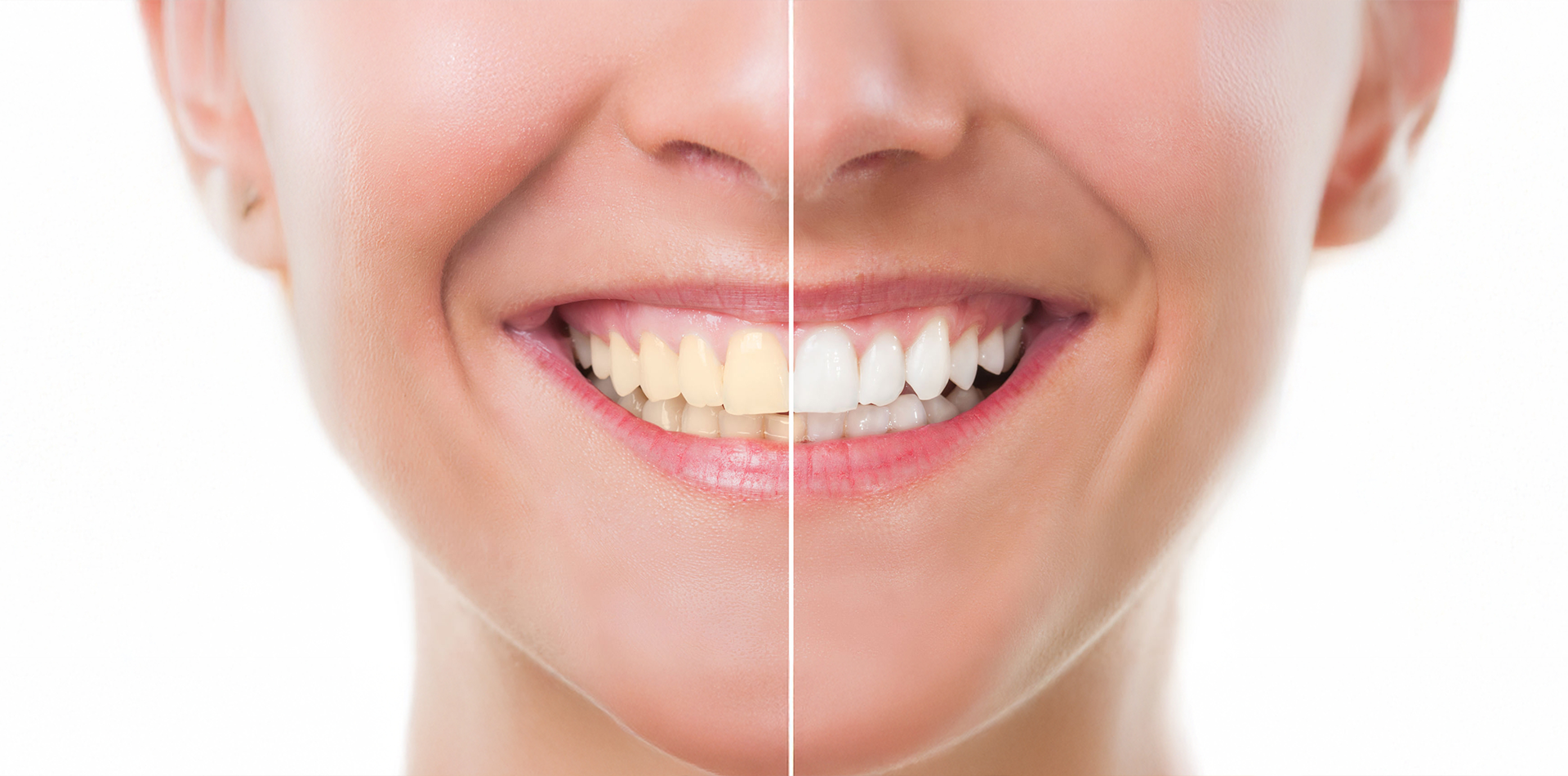 Teeth Whitening in Andheri West