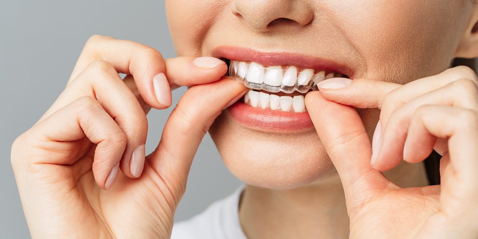 change your smile appearance with teeth aligners