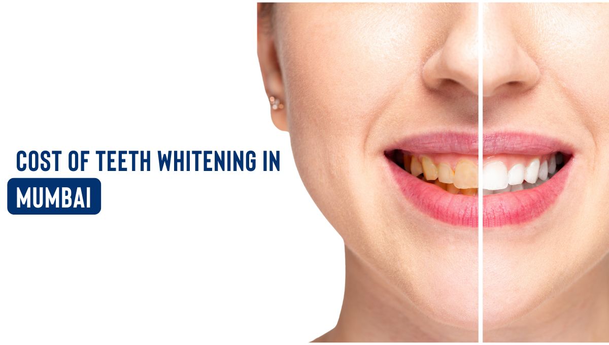 teeth whitening cost in mumbai