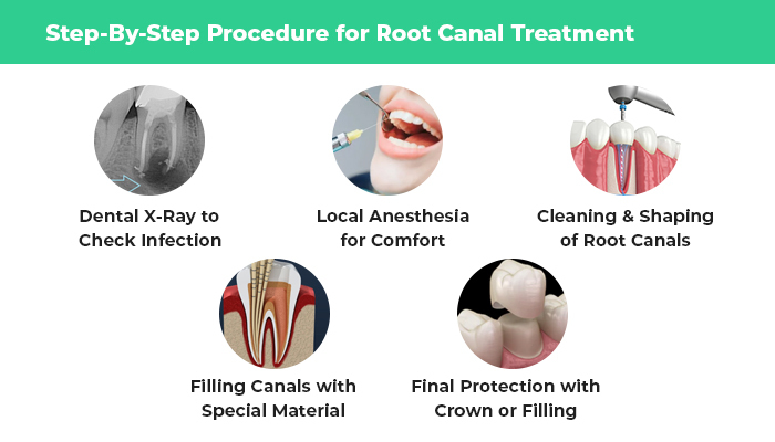 root canal