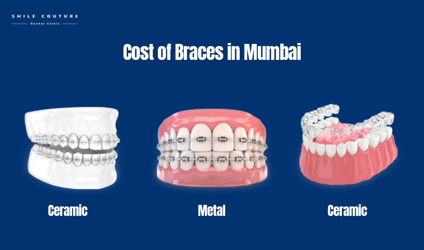 cost of braces in mumbai