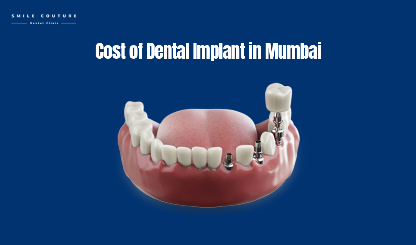 dental implant cost in mumbai