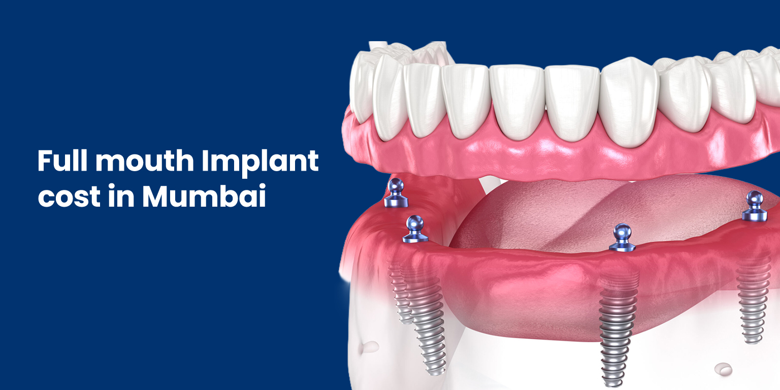 full mouth implant cost in mumbai