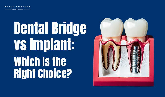 dental bridge vs implant: which is the right choice?