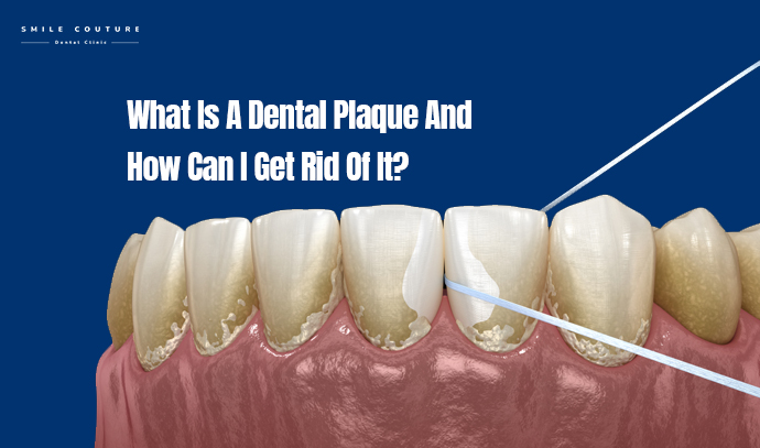 causes, prevention, treatment & removal of dental plaque,